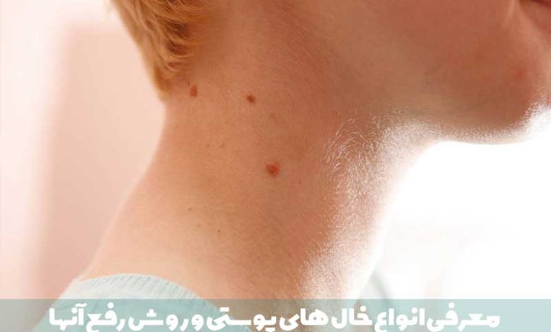 معرفی 8 نوع خال‌ پوستی (دلیل ایجاد + روش درمان)