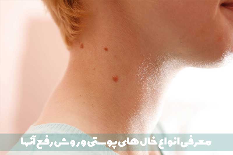 معرفی 8 نوع خال‌ پوستی (دلیل ایجاد + روش درمان)