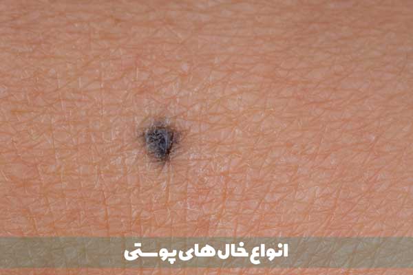 معرفی 8 نوع خال پوستی (دلیل ایجاد + روش درمان)